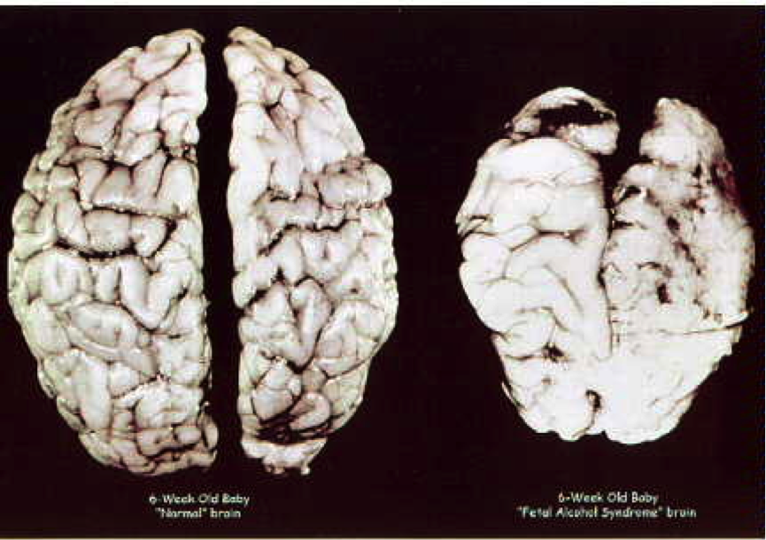 FAS brain comparison image blog.png